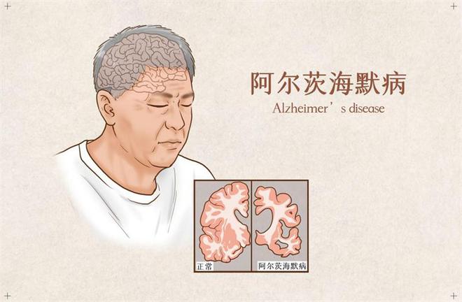 阿尔茨海默病新治疗方法：抑制Mdm2的蛋白质有可能阻止疾病进展【附神经系统药物技术赛道观察图谱】EMC易倍体育 易倍EMC(图1)